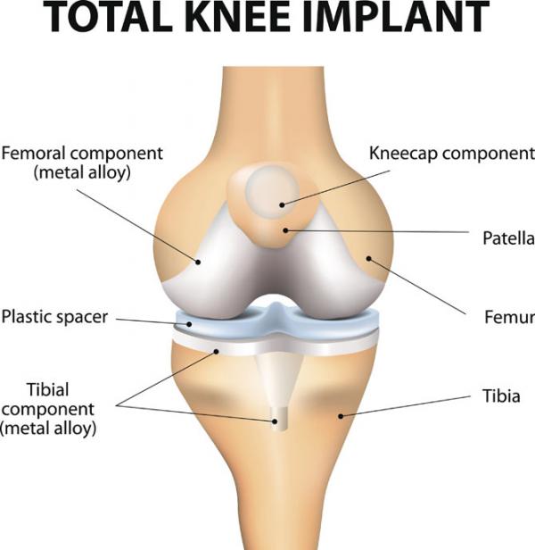 Government slashes knee implant cost by 70 per cent