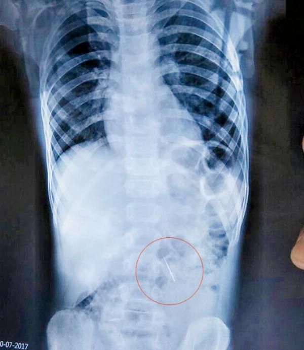 Pune: Dentist drops needle, Pimpri boy swallows it