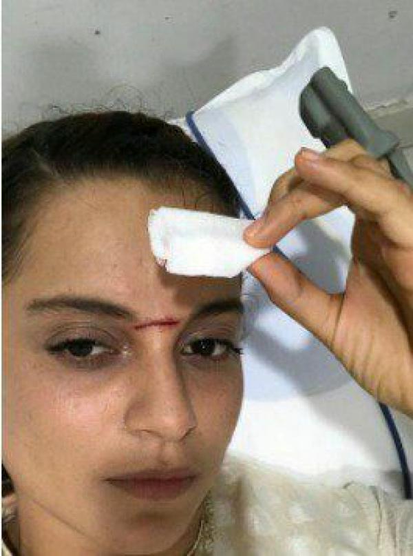 Photo: Kangana Ranaut Hospitalised After Being Hit By Sword On Sets Of Manikarnika!