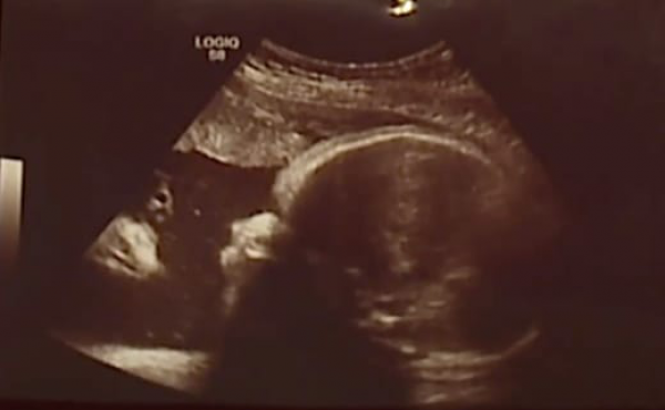 Face of Jesus Appears in Sonogram, Couple Claims