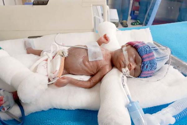 Palm-sized 'baby' fights for life as Mira Road couple struggles for funds