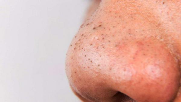 5 Manly Ways To Remove Blackheads From Your Face