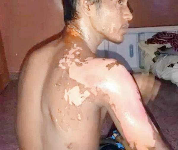 Mistaken for a petrol thief, youth attacked with acid in Virar