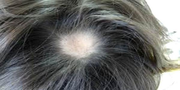 Hair loss increases risk of developing non-cancerous tumours in uterus
