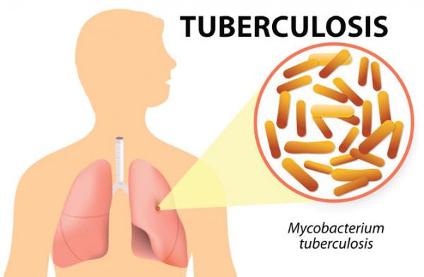 Study finds consuming vitamin C increases efficacy of TB drugs 